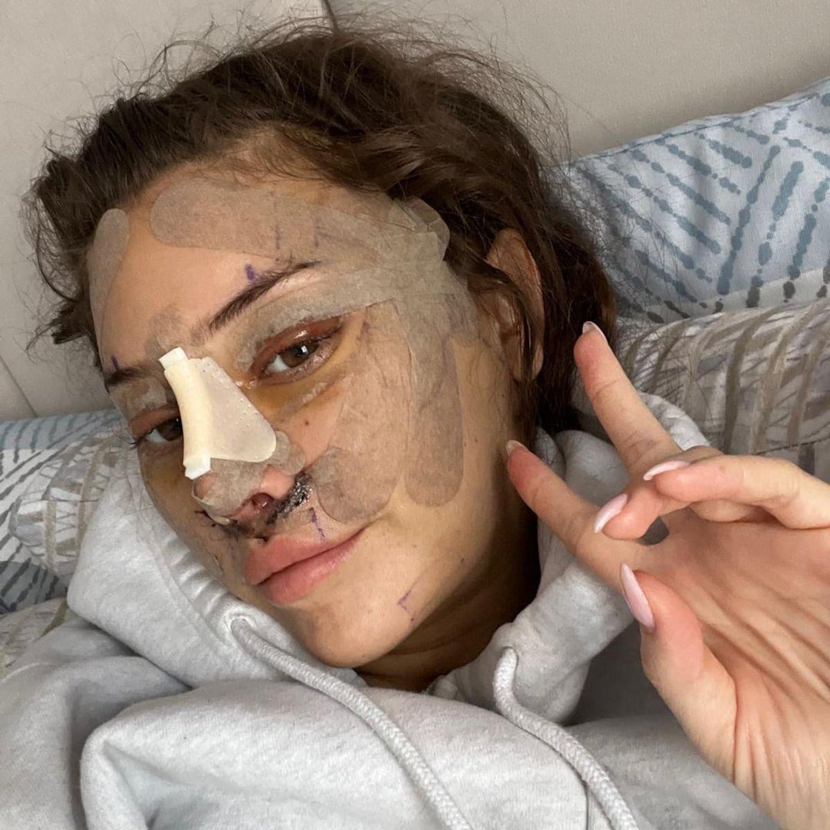 ‘Me quedé dormida y desperté con una cara nueva’: la chica de 28 años que se hizo un estiramiento facial y por qué cada vez más jóvenes lo hacen