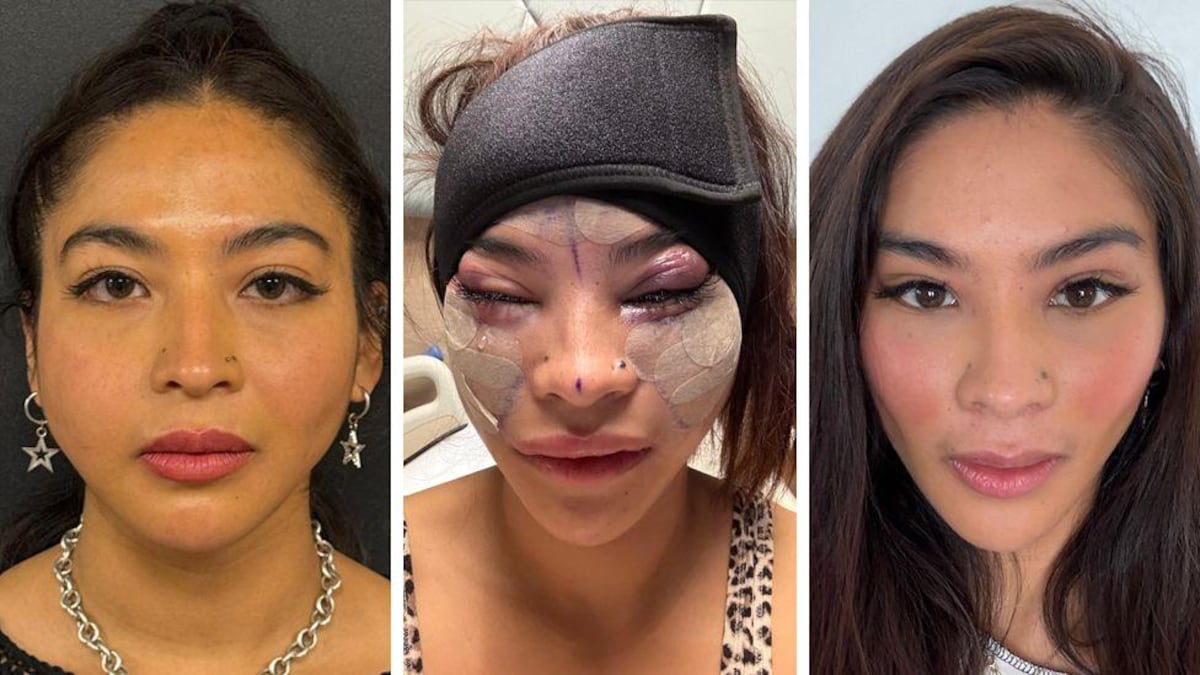 ‘Me quedé dormida y desperté con una cara nueva’: la chica de 28 años que se hizo un estiramiento facial y por qué cada vez más jóvenes lo hacen