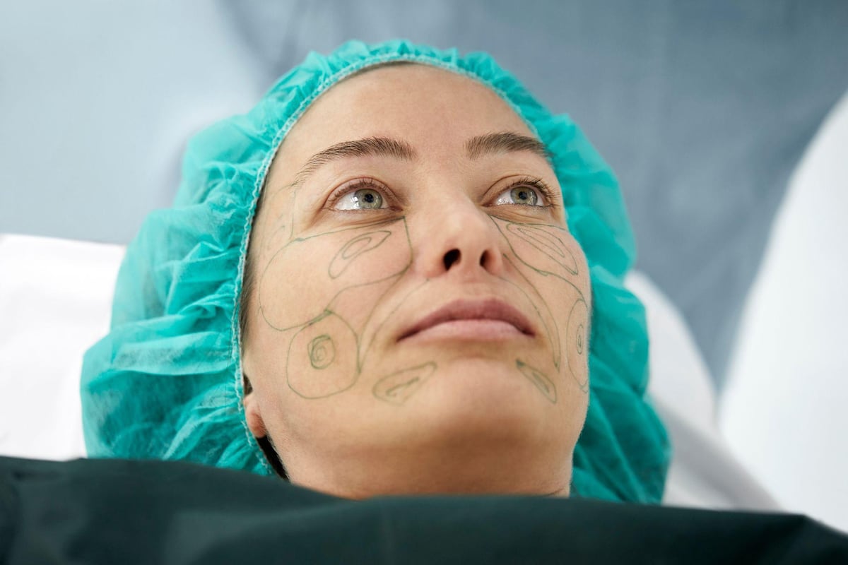 ‘Me quedé dormida y desperté con una cara nueva’: la chica de 28 años que se hizo un estiramiento facial y por qué cada vez más jóvenes lo hacen