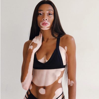 Winnie Harlow, la modelo con vitiligo que desfilará para Victoria’s Secret