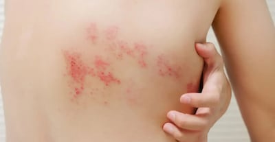 Herpes zóster: el virus que queda dormido tras la varicela y puede reactivarse con los años
