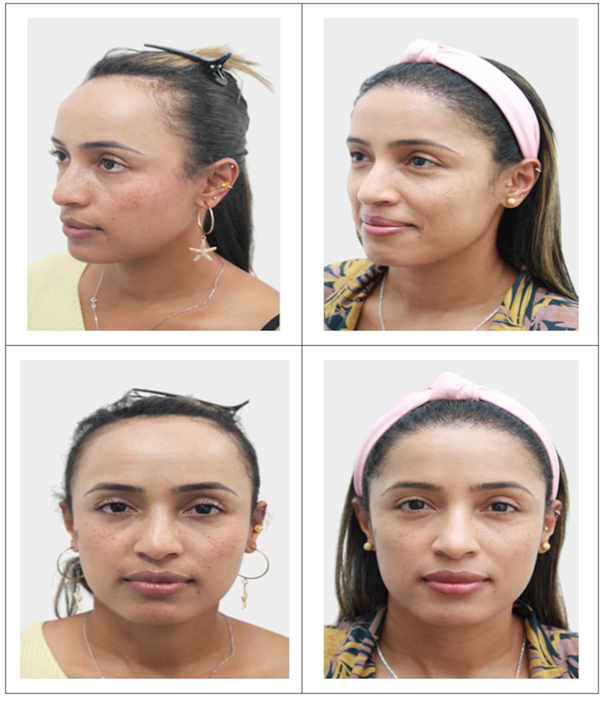 La Importancia del cabello en las mujeres y de una adecuada línea de implantación frontal para la estética del marco facial