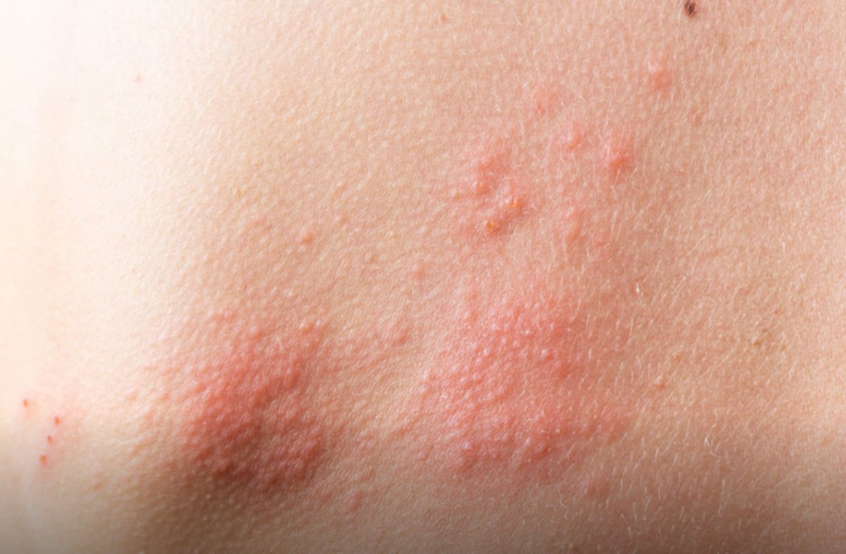 Herpes zóster: el virus que queda dormido tras la varicela y puede reactivarse con los años