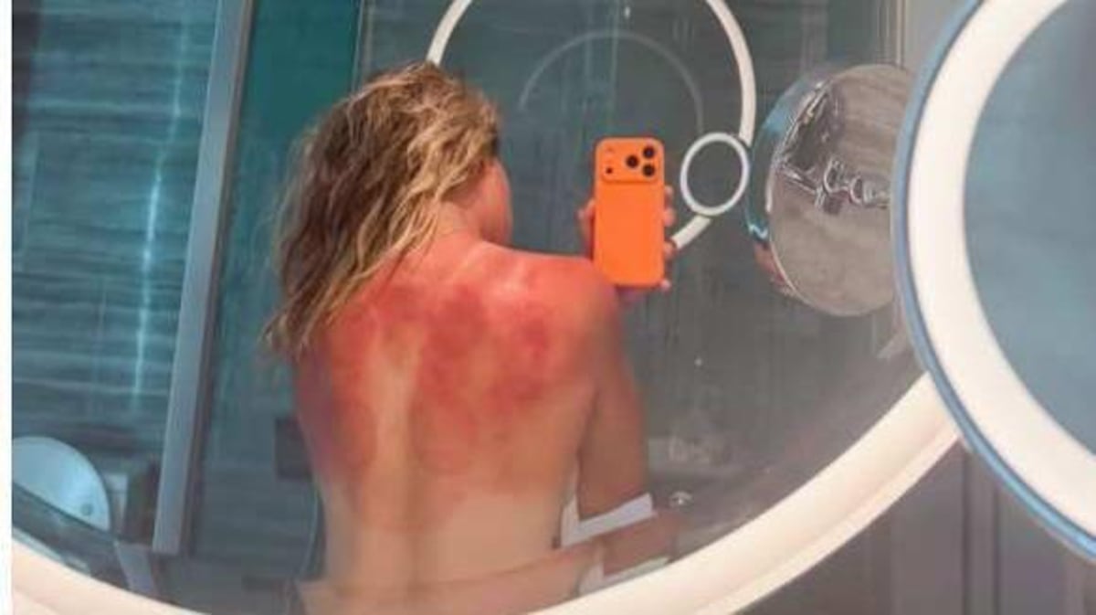 “El sol de Australia no es broma”: la foto de una tenista mexicana que muestra el riesgo en el país con las tasas de cáncer de piel más altas del mundo