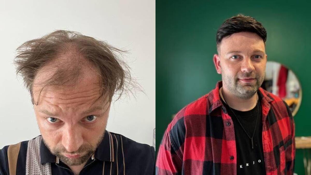 “Comencé a perder mi cabello a los 16 años y eso cambió mi vida por completo”
