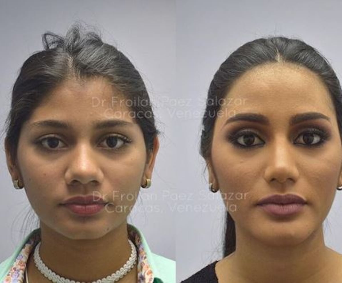 La impresionante transformación facial de Sthefany Gutiérrez, Miss Venezuela