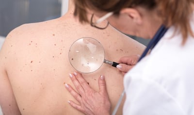 Ocho casos sospechosos de cáncer de piel, detectados en jornada gratuita de revisión de lunares en 2025