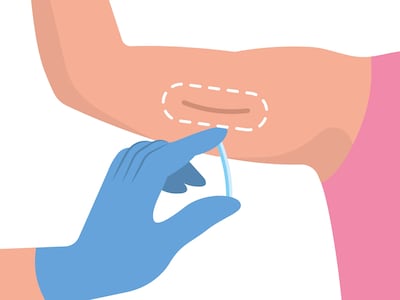 Me puse el implante anticonceptivo y así fue mi experiencia