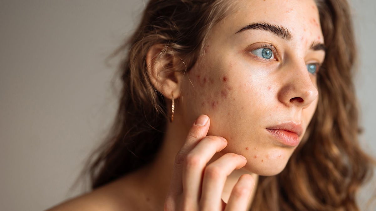 5 consejos de expertos para que los adolescentes cuiden su piel