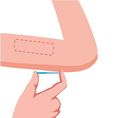 El implante subdérmico anticonceptivo y las preguntas que todas se hacen