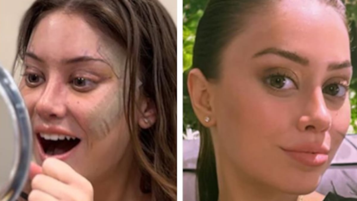 ‘Me quedé dormida y desperté con una cara nueva’: la chica de 28 años que se hizo un estiramiento facial y por qué cada vez más jóvenes lo hacen